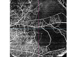 OCTアンギオグラフィーによる撮影画像（網膜血管閉塞による循環障害）