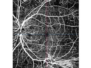 OCTアンギオグラフィーによる撮影画像（糖尿病網膜症による網膜新生血管）