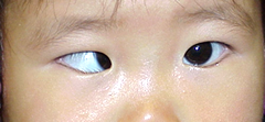 症例:乳児内斜視